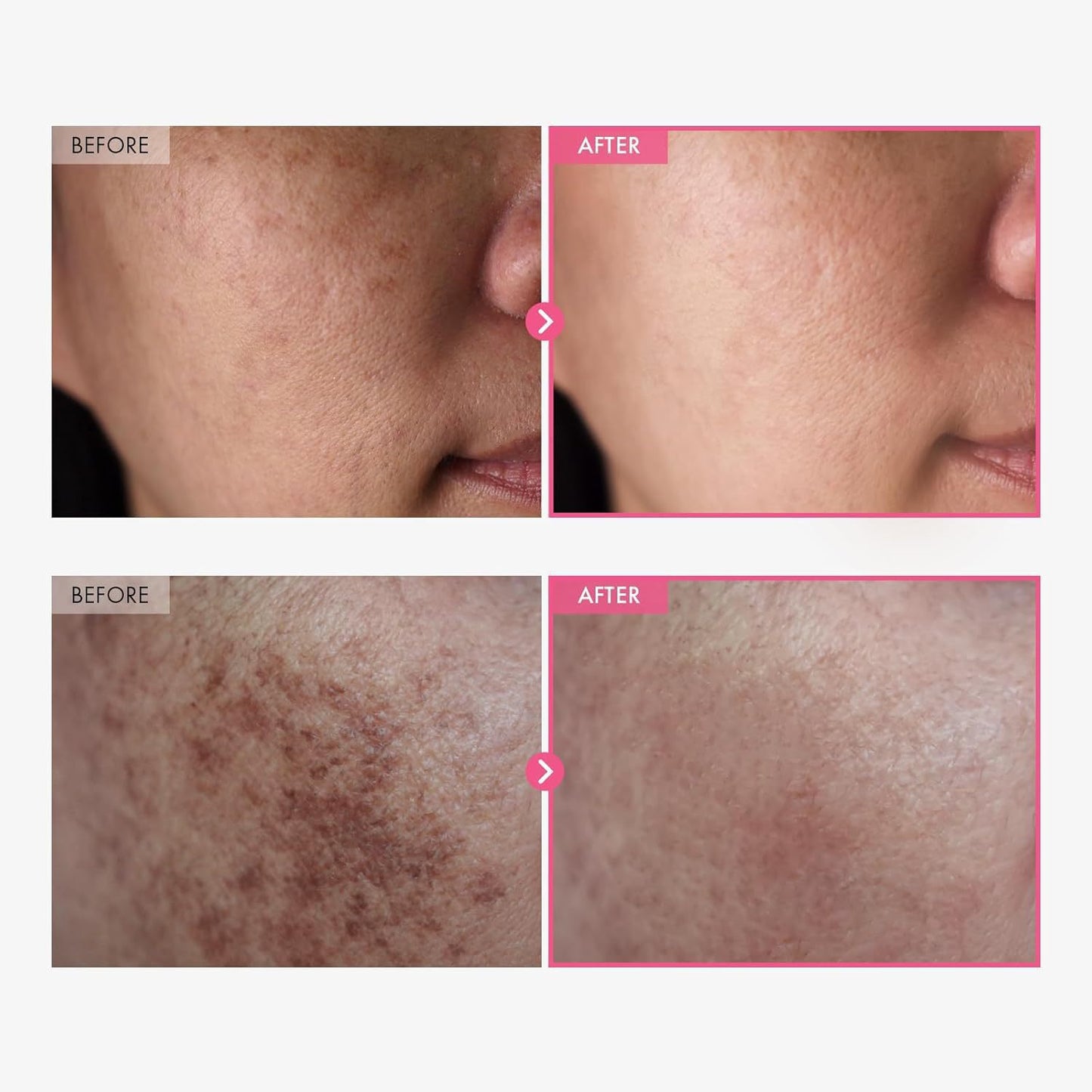 Tosowoong Arbutin 7% + Tranexamic Acid 4% Cream — Fade Dark Spots & Even Skin Tone
